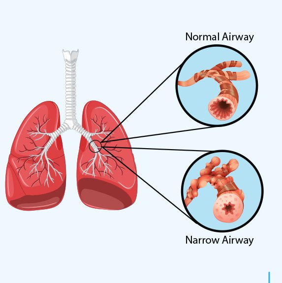 Definition of Asthma